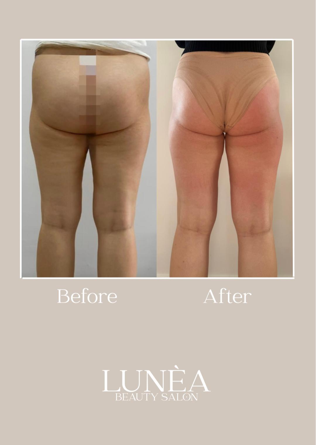 Lunea beauty #zagreb Anticelulit masaža Maderoterapija - 40 minuta