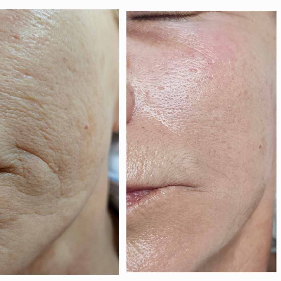 Ten #zagreb Dermaroler i dermapen Dermapen lica + vrata