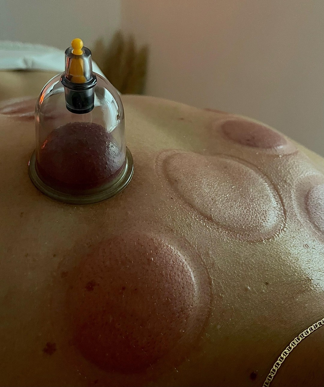 Madero&Beauty Gabrijela #zagreb Tretmani tijela Masaža leđa + Cupping terapija leđa