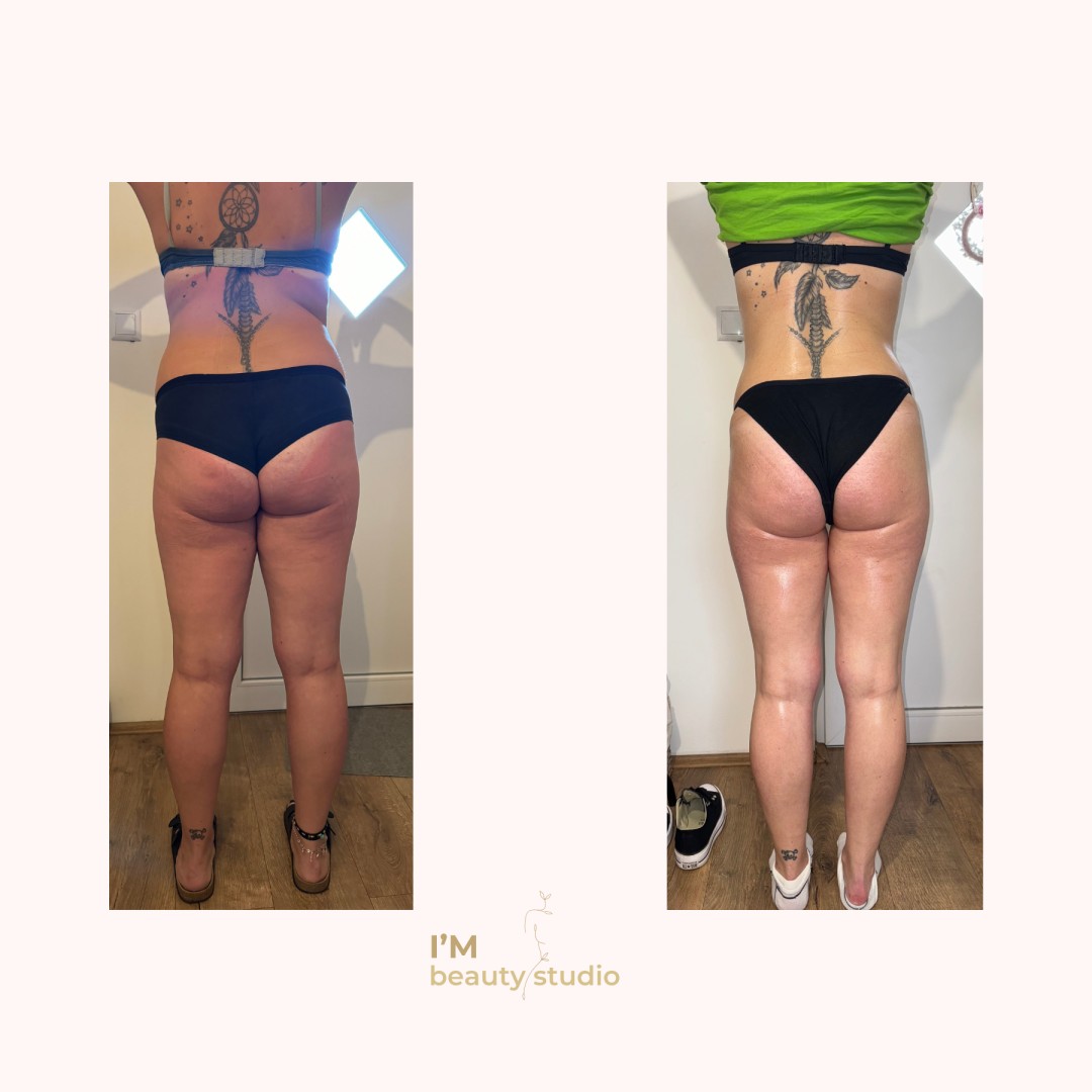 I'M beauty studio #zagreb Anticelulit Promo paket - 10x brazilska maderoterapija (noge gluteus trbuh leđa) - za dame