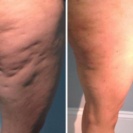 Estetix centar #zagreb Tretmani tijela Mega paket tretmana