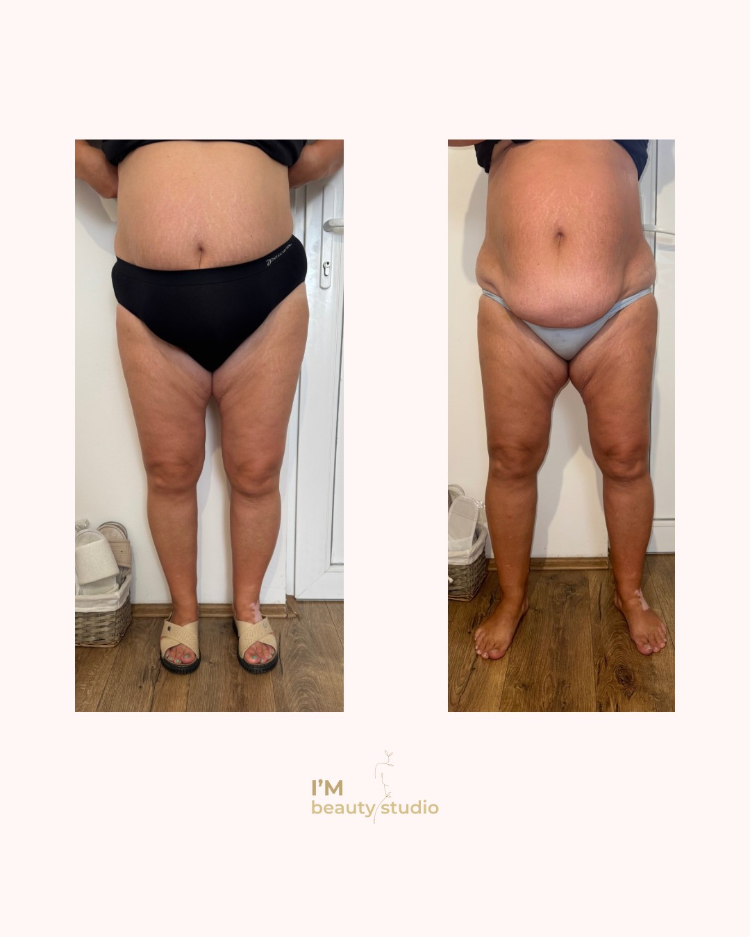 I'M beauty studio #zagreb Anticelulit Promo paket - 10x brazilska maderoterapija (noge gluteus trbuh leđa) - za dame