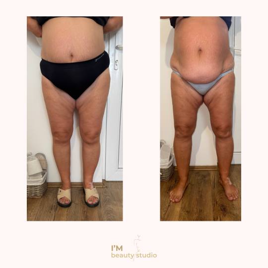 I'M beauty studio #zagreb Anticelulit Promo paket - 10x brazilska maderoterapija (noge gluteus 