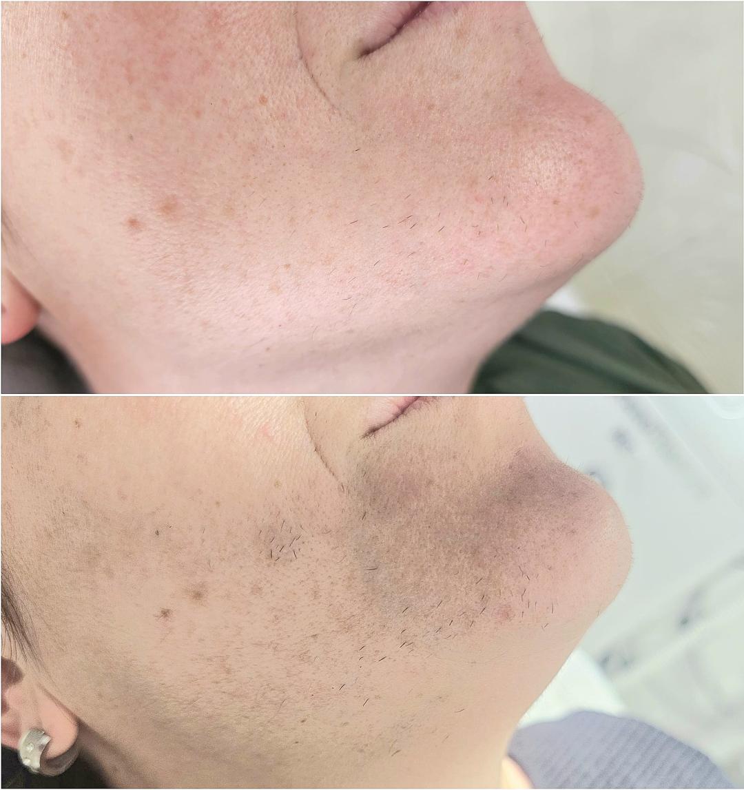 S M Beauty Bloom #zadar Laserska epilacija Laserska epilacija brade