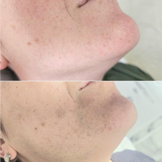 S M Beauty Bloom #zadar Laserska epilacija Laserska epilacija brade Nakon 3 tretmana