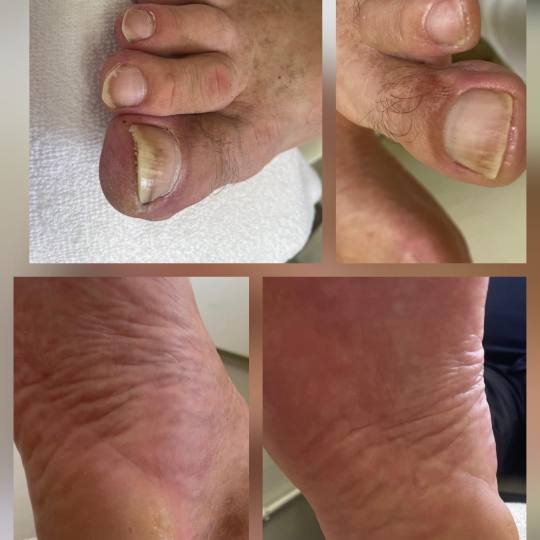 Tinka #zagreb Ovo je nježnija verzija medicinske pedikure, a za zahtjevnije slučajeve — tu smo s