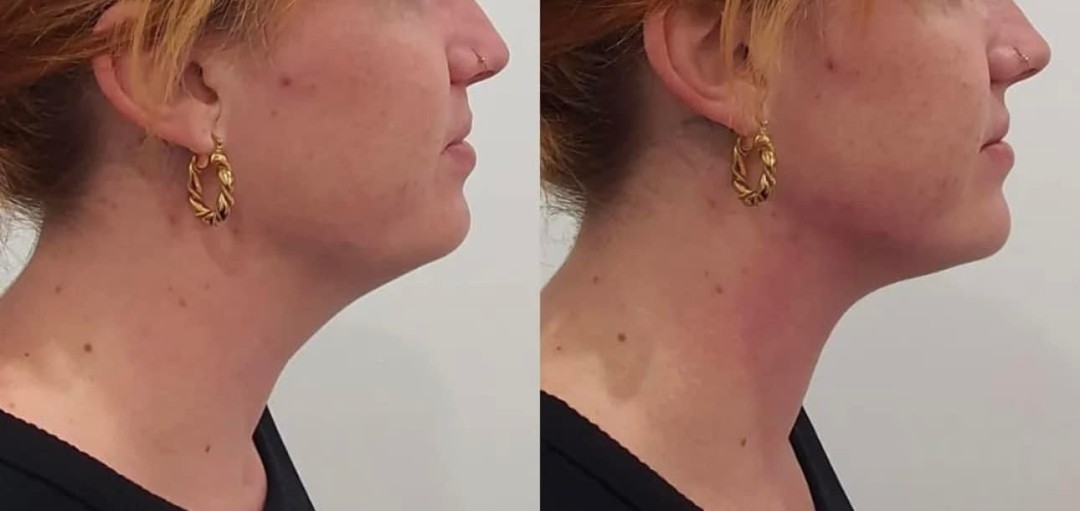 Estetix centar #zagreb Tretman lica Tretman 448 lica + podbratka + podočnjaka - paket od 4 tretmana