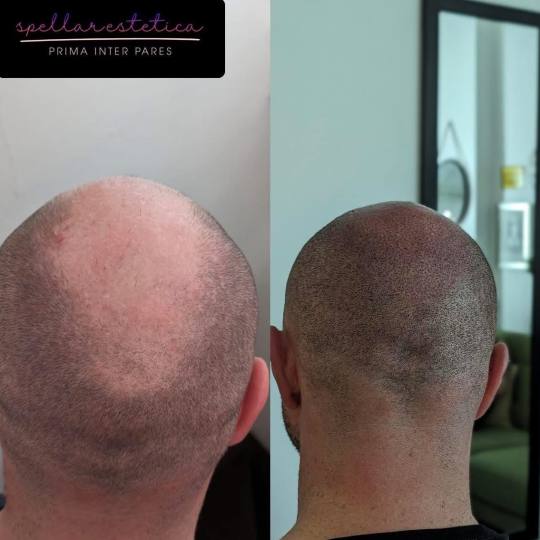 Spellar - Križ #kriz Mikro pigmentacija skalpa - cijena na upit