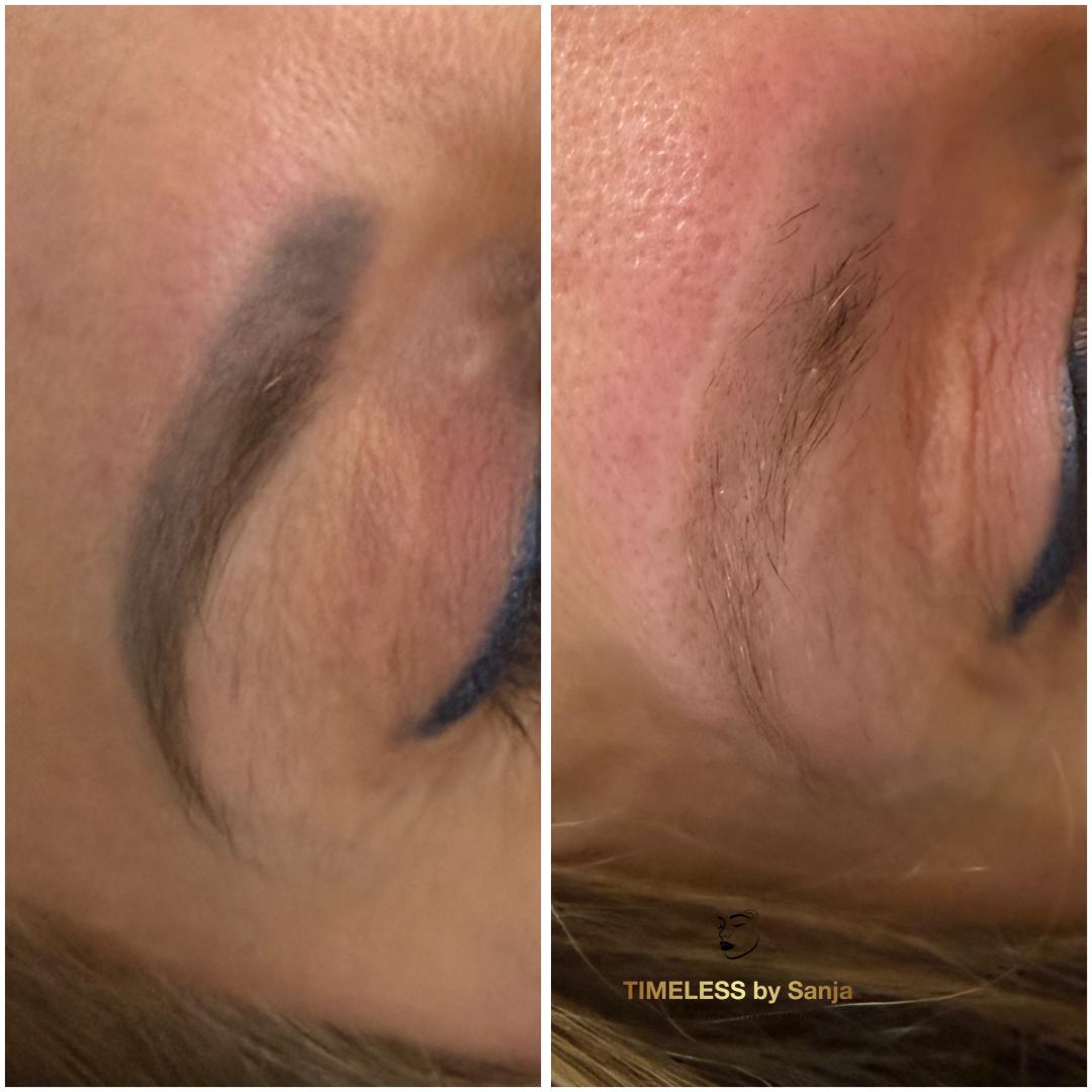 Timeless by Sanja #zagreb Uklanjanje tetovaža Lasersko uklanjanje obrva