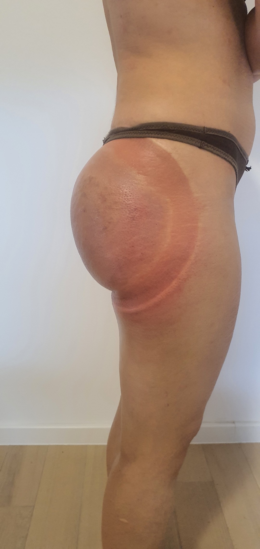 SOLO Beauty Centar #zagreb Tretmani tijela Butt lift vacuum