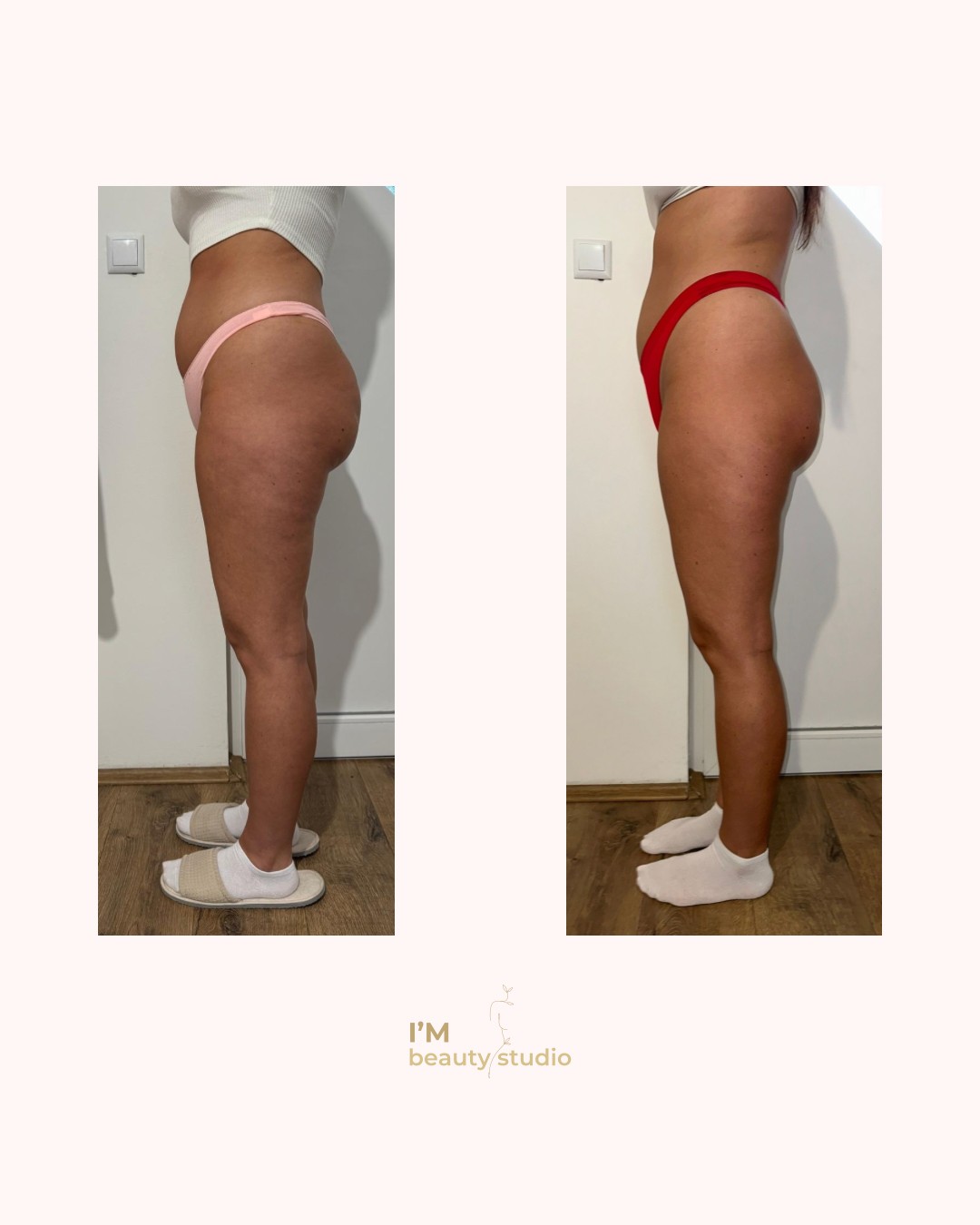 I'M beauty studio #zagreb Anticelulit Promo paket - 10x brazilska maderoterapija (noge gluteus trbuh leđa) - za dame