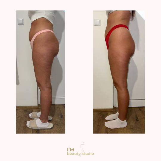 I'M beauty studio #zagreb Anticelulit Promo paket - 10x brazilska maderoterapija (noge gluteus 