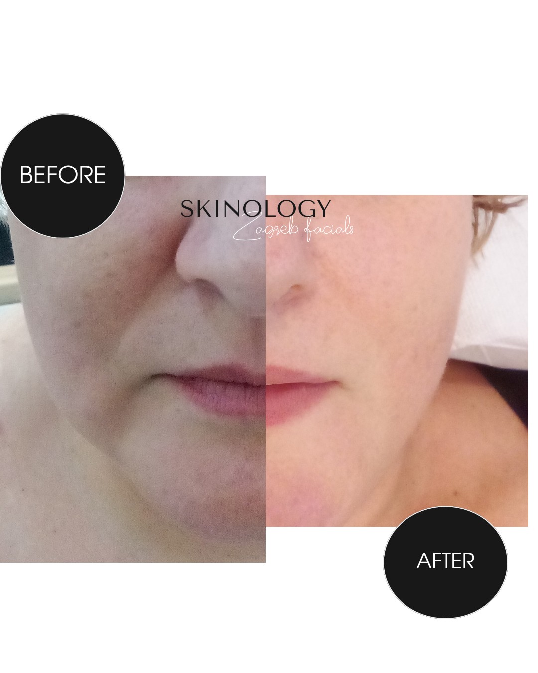 Revita - HA therapy - Skinology Zagreb facials, Zagreb Tretman lica Lice Tretman lica, Zagreb, Donji grad - Centar