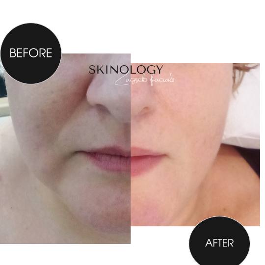 Skinology Zagreb facials #zagreb Tretman lica Revita - HA therapy