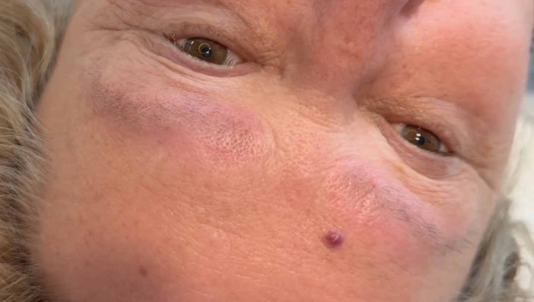 SABRINA STRIJA BEAUTY & SPA #zagreb Uklanjanje tetovaža Lasersko uklanjanje tetovaža - 10 x 10 cm