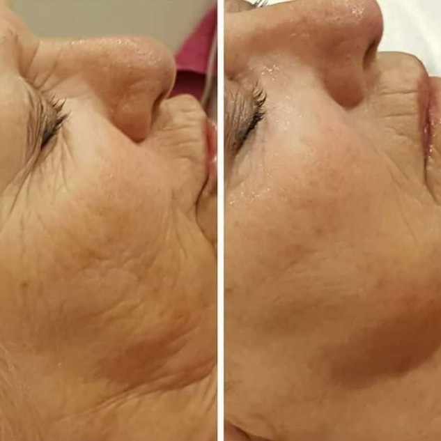 Antiage beauty room Lady Goga #zagreb Tretman lica