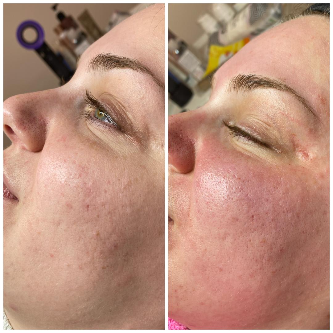 Microneedling / Derma Pen lica - Nefertiti Studio, Zagreb Mezoterapija lica Lice Mezoterapija lica, Zagreb, Peščenica – Žitnjak