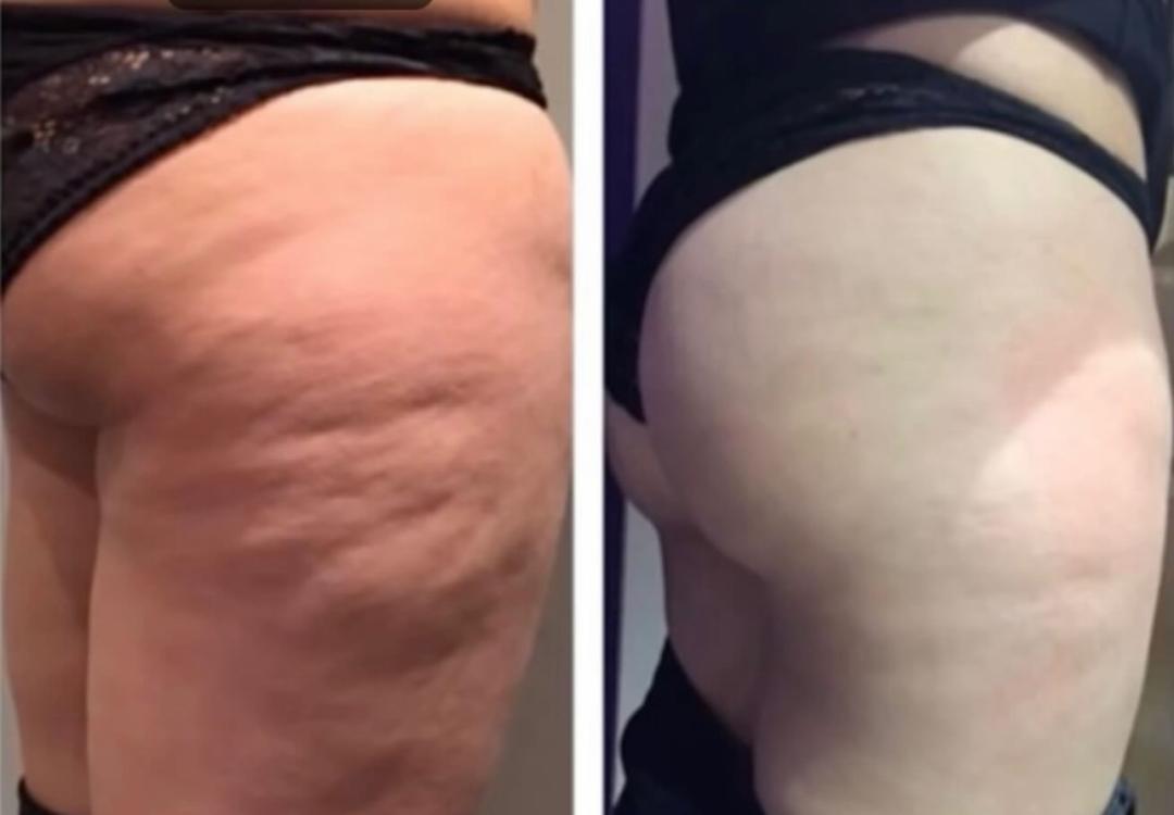 Perfect body beauty bar #zagreb Body wrap / pakovanja Deluxe shape ultrazvučna kavitacija - 60 minuta