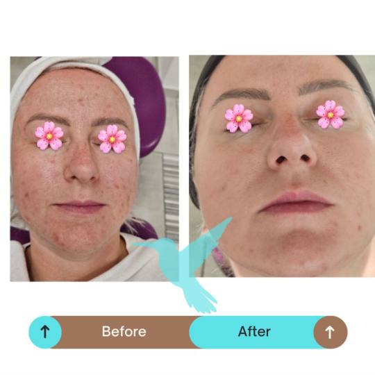 Luma Medic #zagreb Tretman lica SQT revitalizing Smanjite vidljivost pigmentacijiskih mrlja re revit