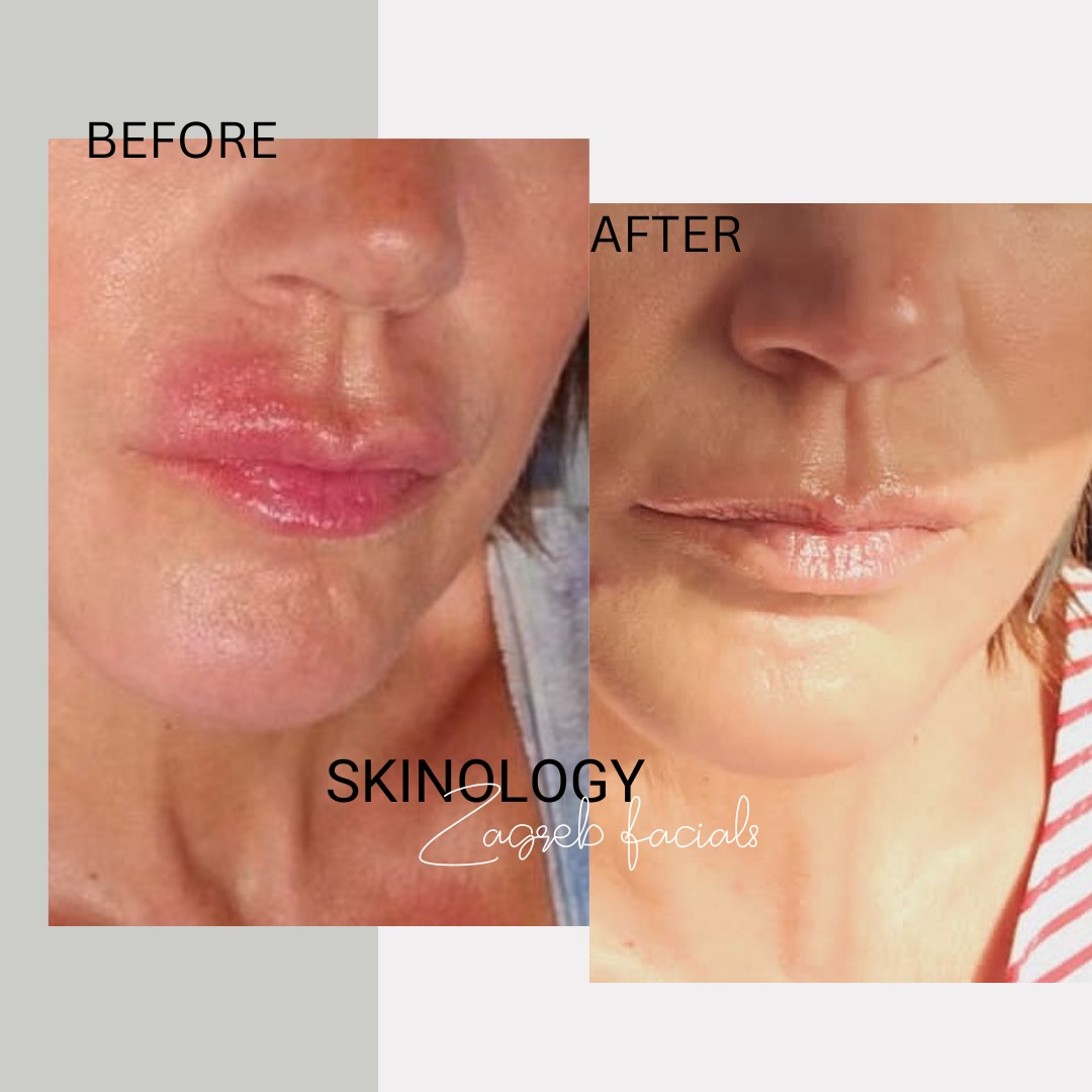 Intense repair - tretman lica - Skinology Zagreb facials, Zagreb Tretman lica Lice Tretman lica, Zagreb, Donji grad - Centar