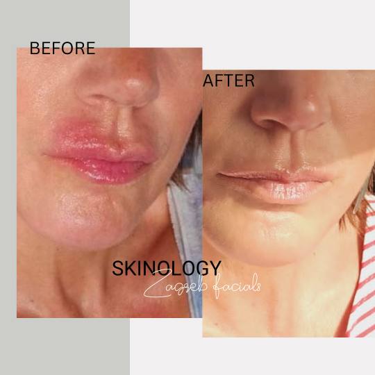 Skinology Zagreb facials #zagreb Tretman lica Intense repair - tretman lica Perioralni neurodermatit