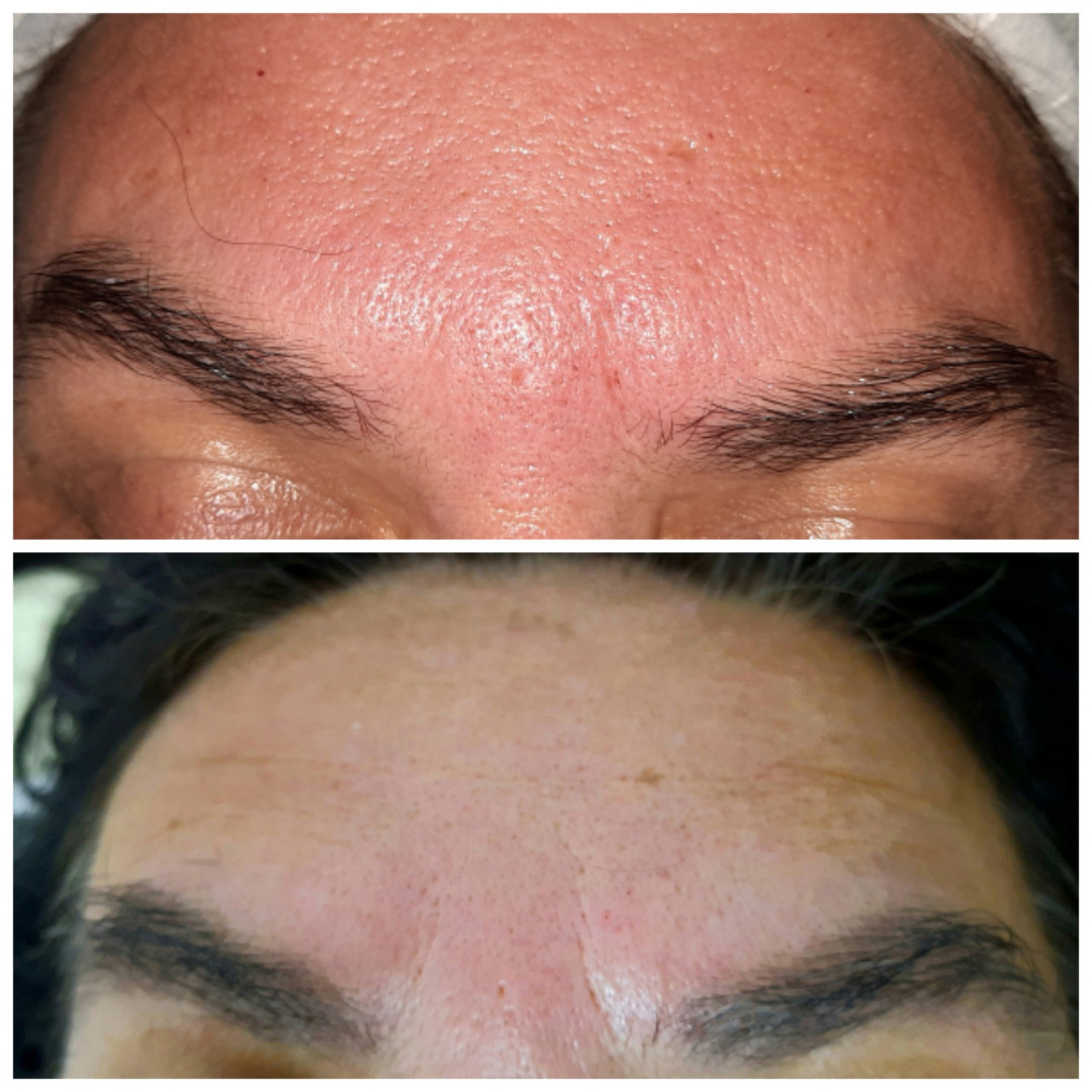 Melanis i Silueta studio za njegu lica i tijela #zagreb Tretman lica Mezoterapija lica + dermaroler - 5 tretmana