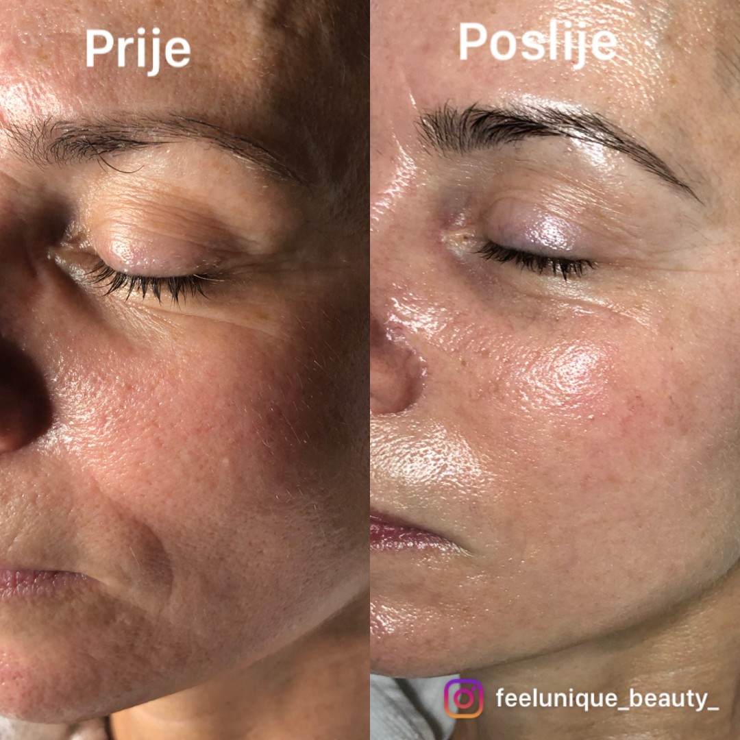 FeelUnique #zagreb Tretman lica Amber Re-Derm Ceremony tretman lica