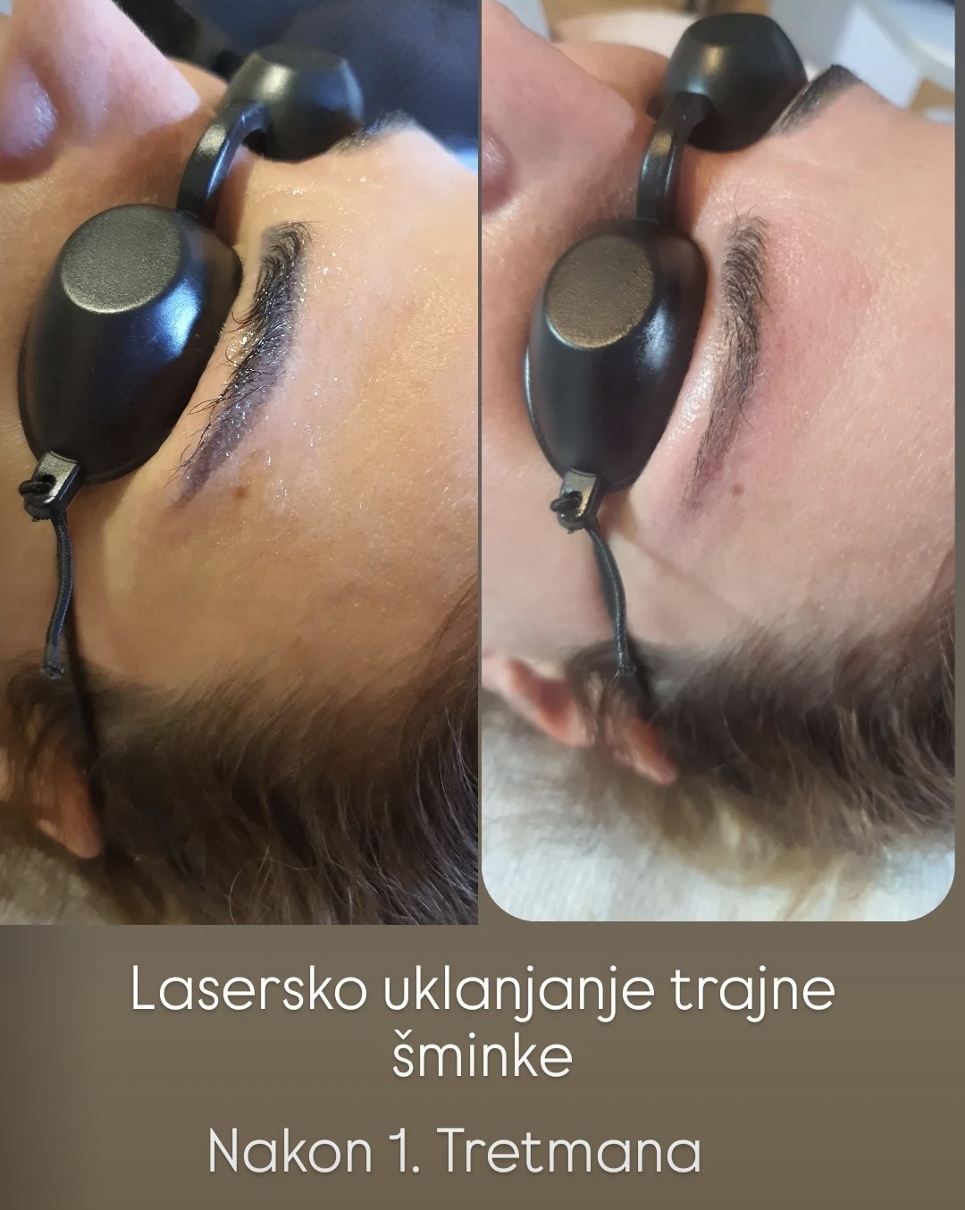 SOLO Beauty Centar #zagreb Trajna šminka Pico laser - uklanjanje trajne šminke obrva - jedna zona