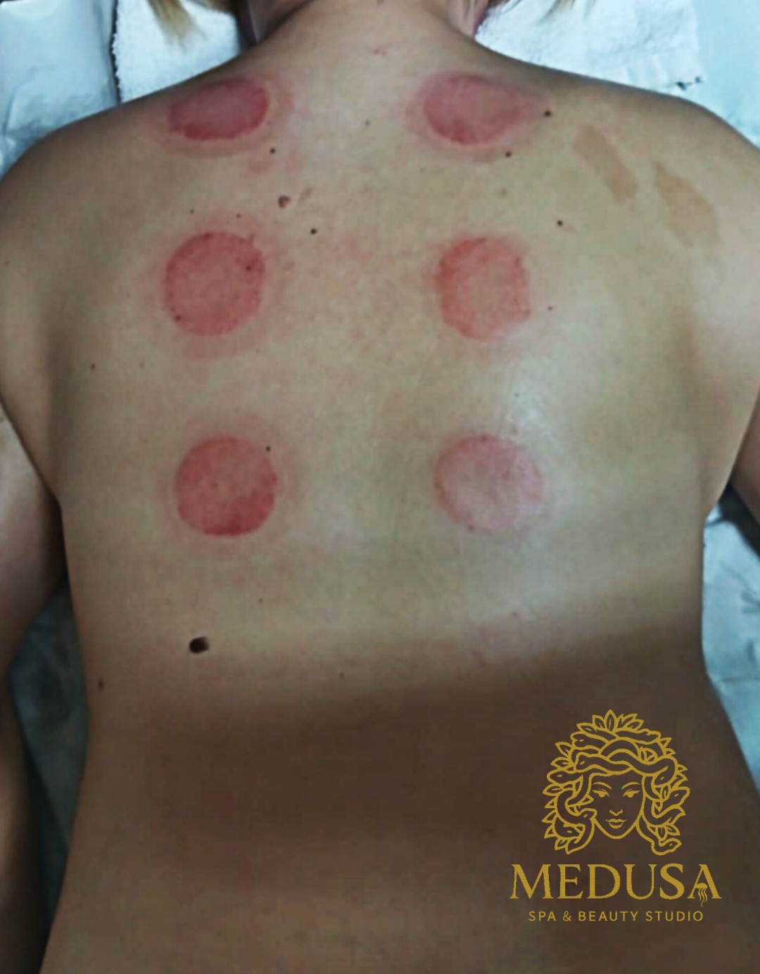 Medusa #osijek Tretmani tijela Cupping masaža - 45 minuta