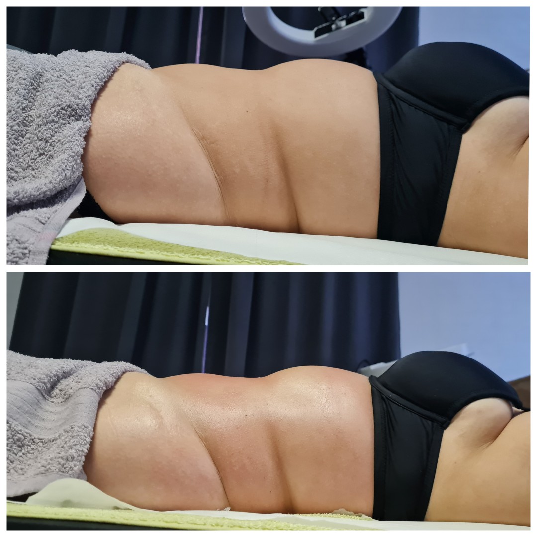 Glitter and glam #zagreb Tretmani tijela Limfno modelovanje - cijelo tijelo