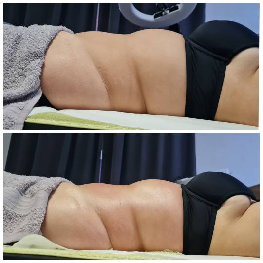 Glitter and glam #zagreb Tretmani tijela Limfno modelovanje - cijelo tijelo