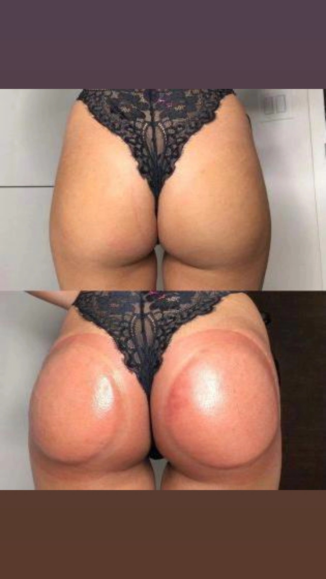 Antiage beauty room Lady Goga #zagreb Anticelulit masaža Ručna anticelulitna masaža