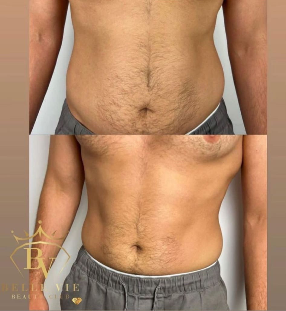 Belle Vie Beauty Club #zagreb Tretmani tijela Tesla tretman dveju regija - paket od 10 tretmana + 2 gratis + RF tehnologija