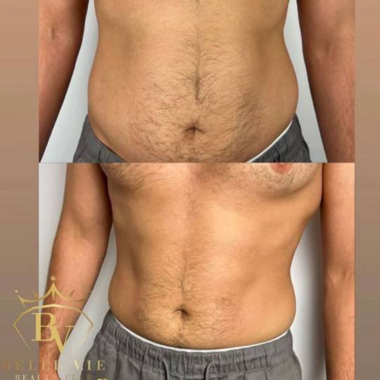 Belle Vie Beauty Club #zagreb Tretmani tijela Tesla tretman dveju regija - paket od 10 tretmana + 2 