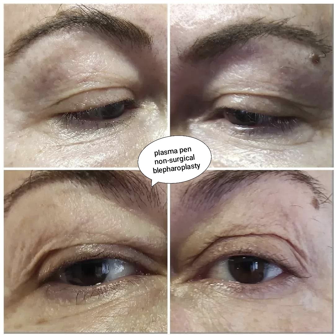 BioLaser Studio Rijeka #rijeka Tretman lica Plasma pen - gornji kapci