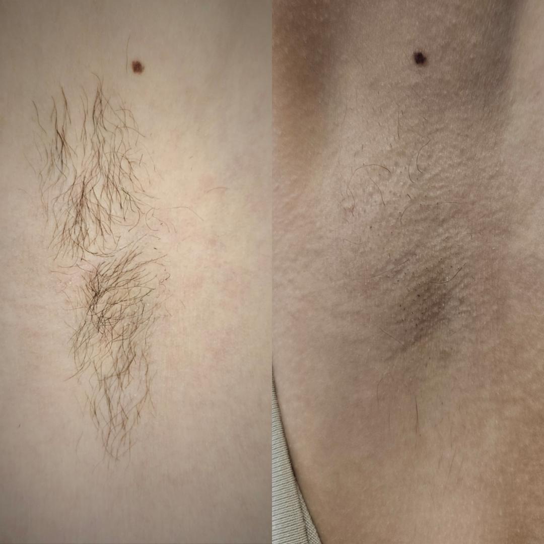 S M Beauty Bloom #zadar Laserska epilacija Laserska epilacija pazuha