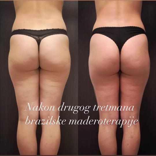 Perfect body beauty bar #zagreb Anticelulit masaža Brazilska maderoterapija - 30 minuta