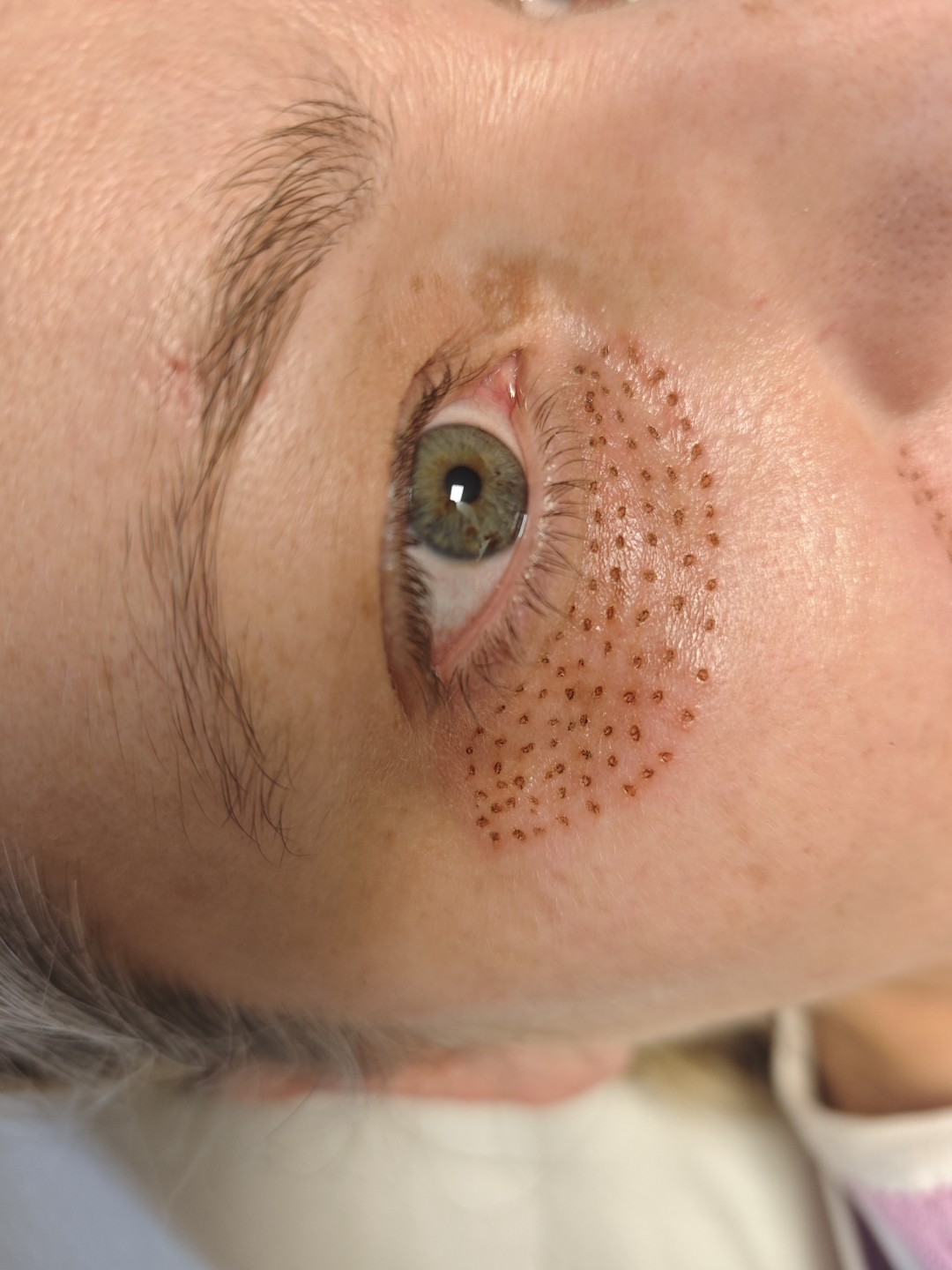 BioLaser Studio Rijeka #rijeka Tretman lica Plasma pen - podočnjaci