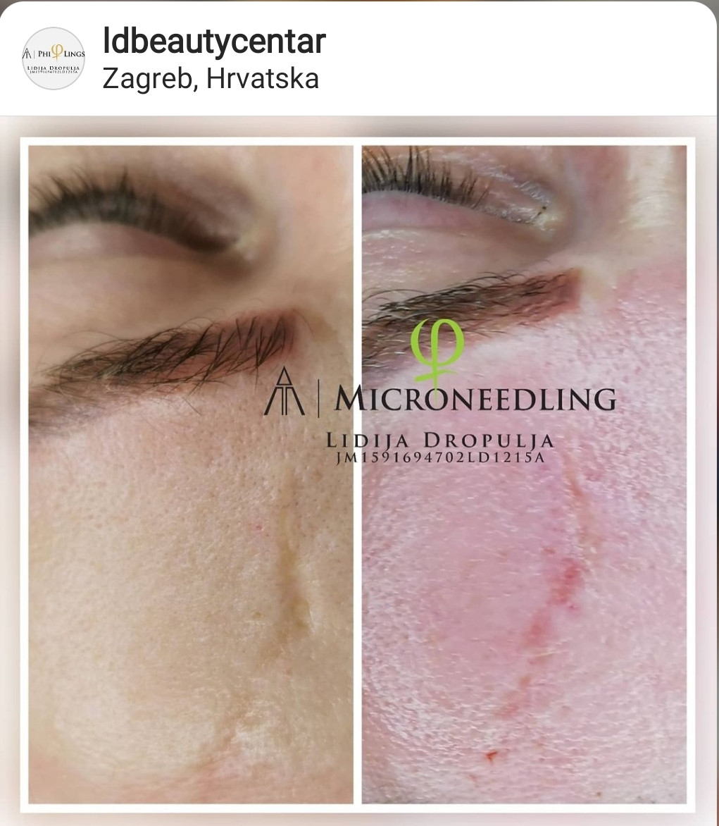 LD Beauty Centar #zagreb Mezoterapija lica Microneedling uklanjanje ožiljaka