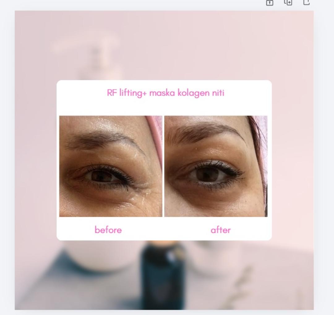 Ag beauty time studio #zagreb Depilacija šećernom pastom Maska kolagen niti+rf lica-odmah vidljivi rezultati!!! Ublažava bore