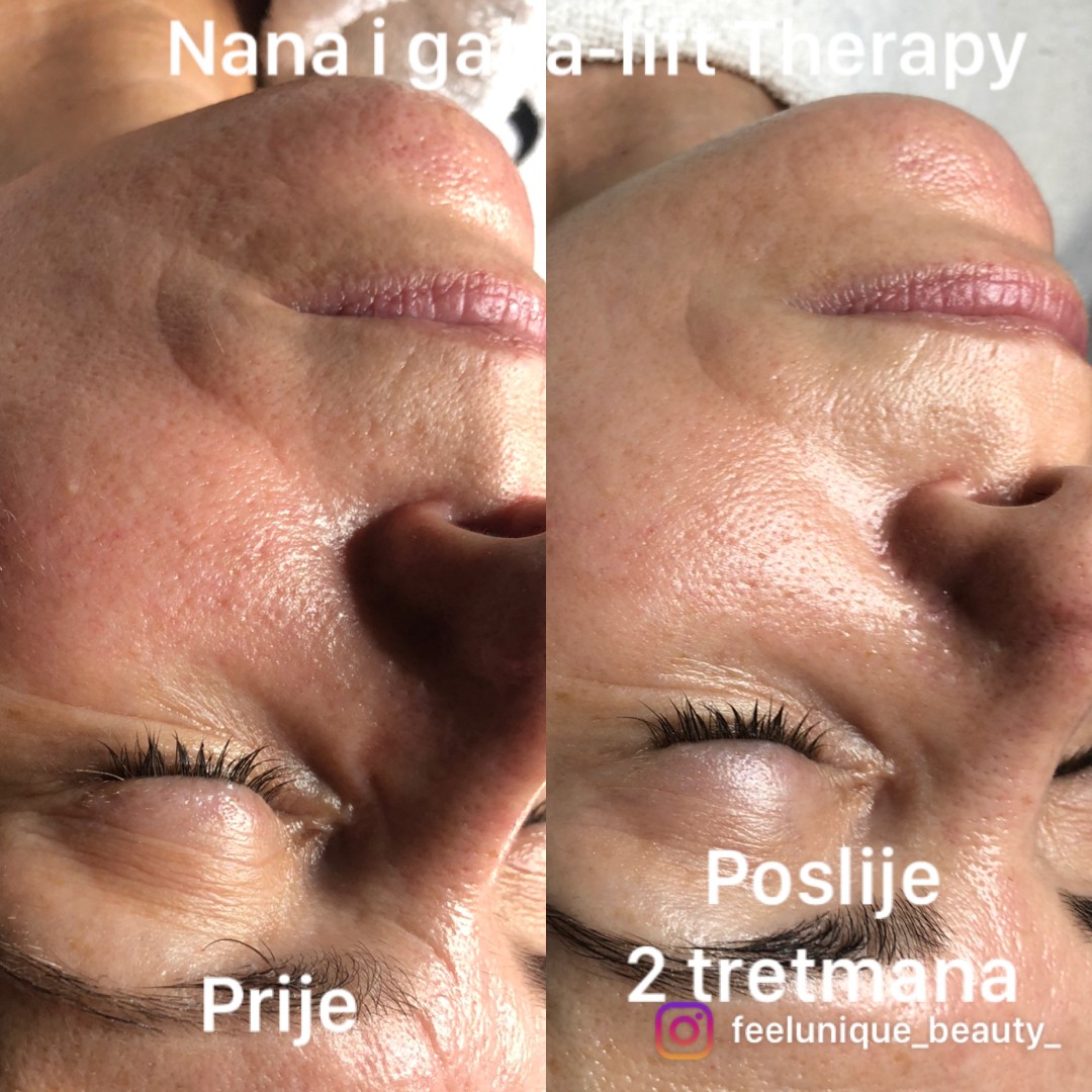 FeelUnique #zagreb Tretman lica Nana i Gaba lift therapy - lifting / pomlađivanje