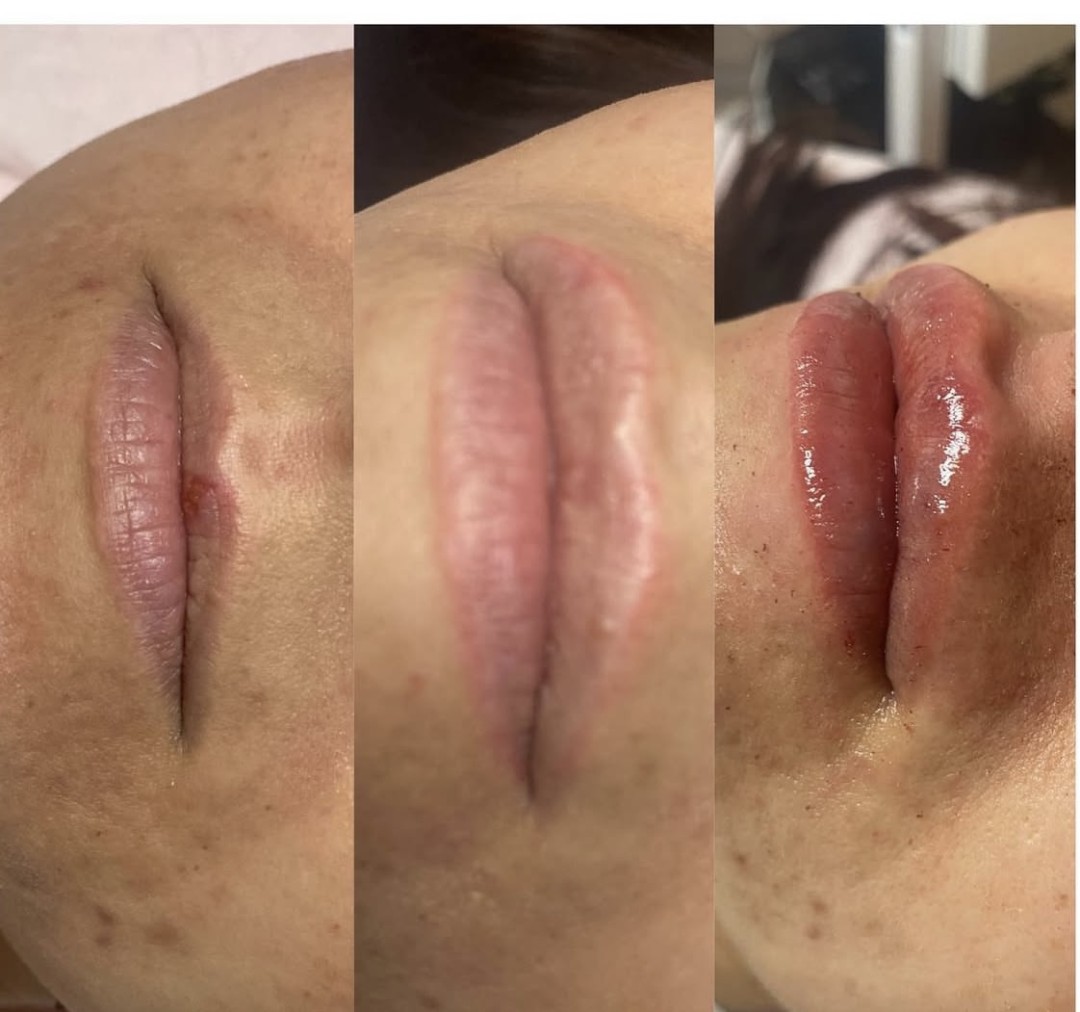 Nefertiti Studio #zagreb Hijaluronski tretmani lica Hyaluron Pen usana - 1ml