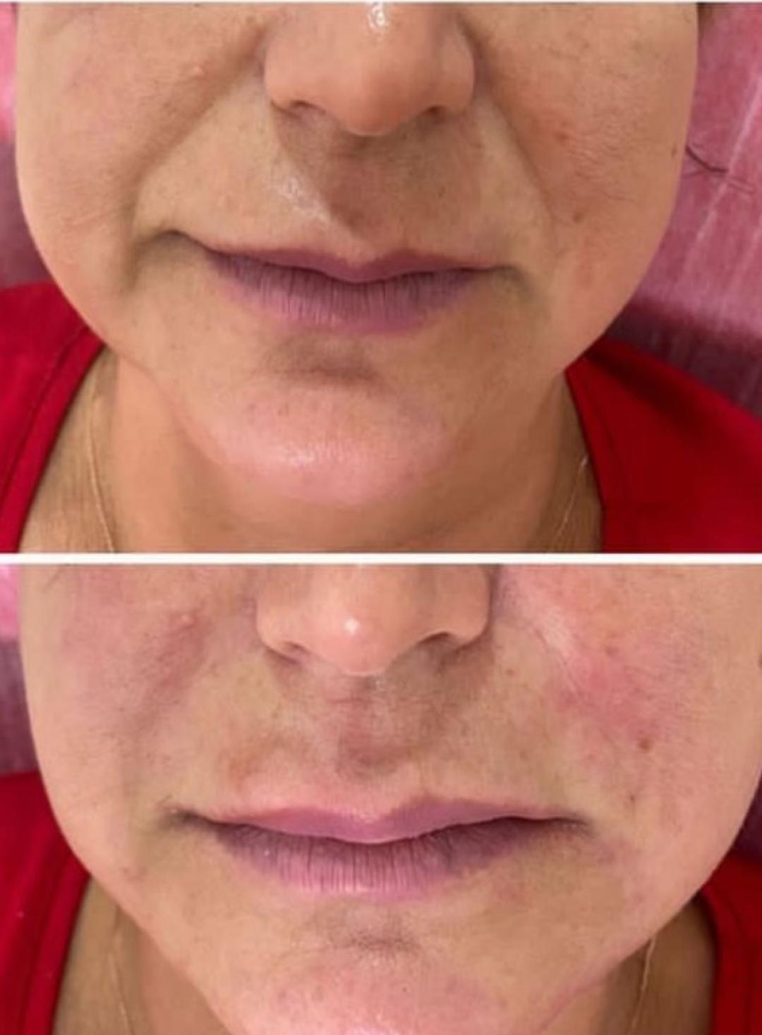 Perfect body beauty bar #zagreb Tretman lica Resurface Diego dalla Palma - kemijski peeling protokol