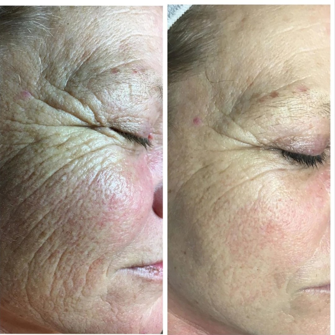 Aromavita Bella Donna #varazdin Tretman lica Chronos therapy