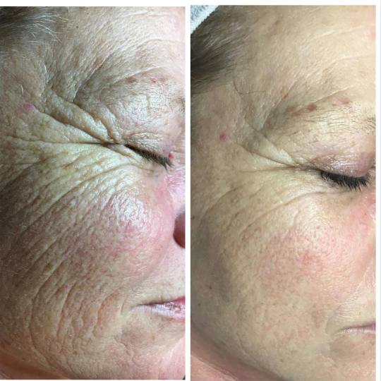 Aromavita Bella Donna #varazdin Tretman lica Chronos therapy Chronos tretman potiče dubinsku regene