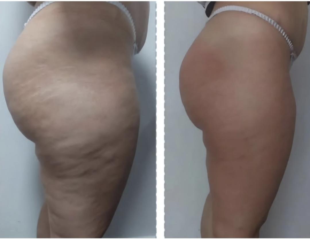 Perfect body beauty bar #zagreb Body wrap / pakovanja Deluxe shape ultrazvučna kavitacija - 60 minuta
