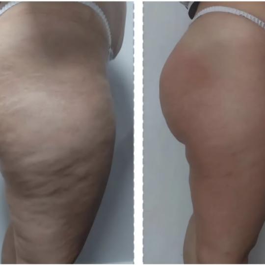 Perfect body beauty bar #zagreb Body wrap / pakovanja Deluxe shape ultrazvučna kavitacija - 60 minu
