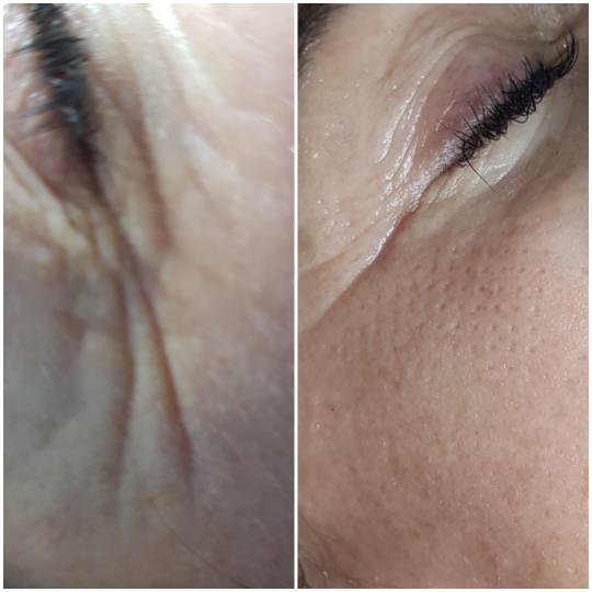 Ten #zagreb Neinvazivan tretman (bez iglica) za ubacivanje preparata poput hyalurona ,vitamina,dna-r