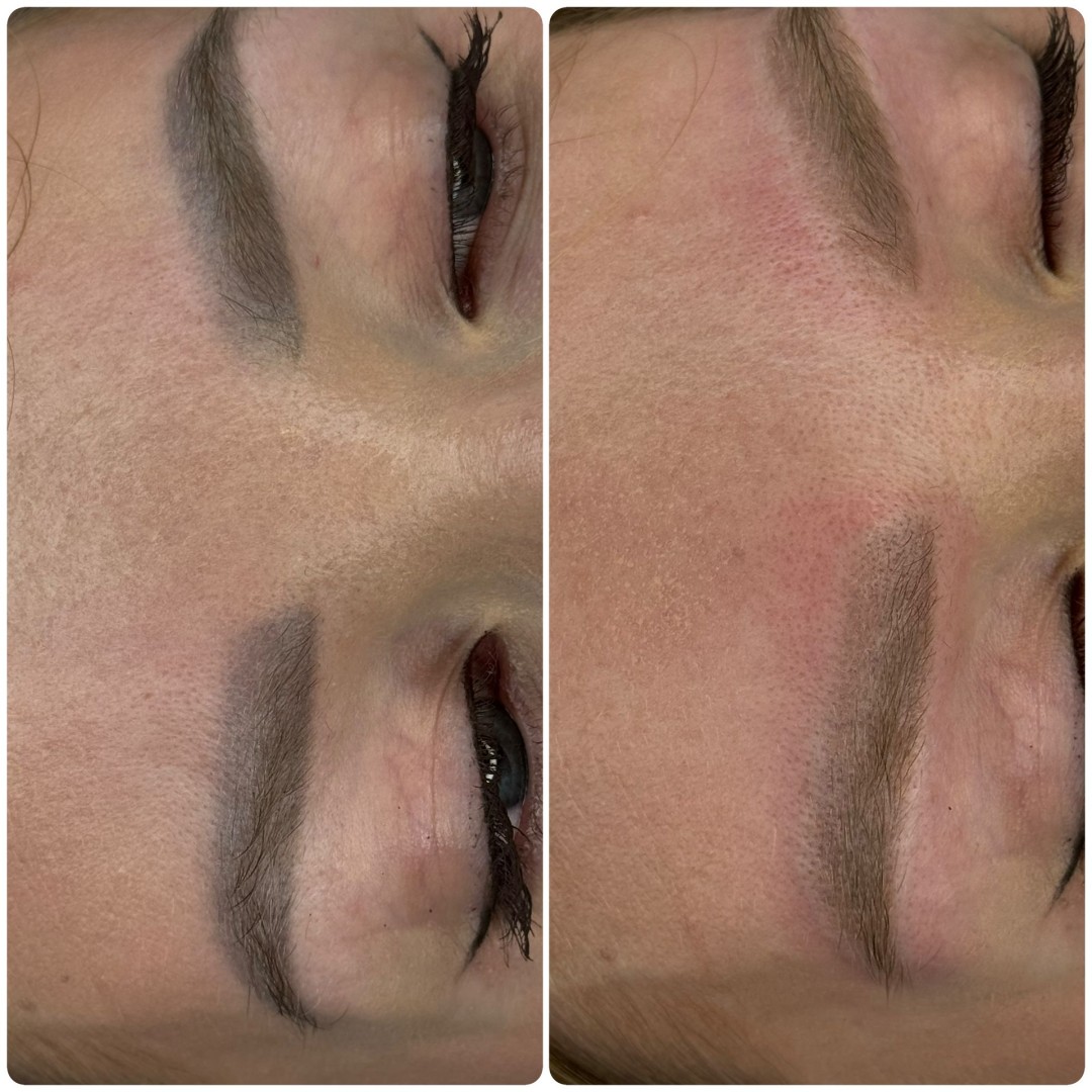 Brow Bar Permanent #zagreb Uklanjanje tetovaža Lasersko uklanjanje tetovaže - obrve