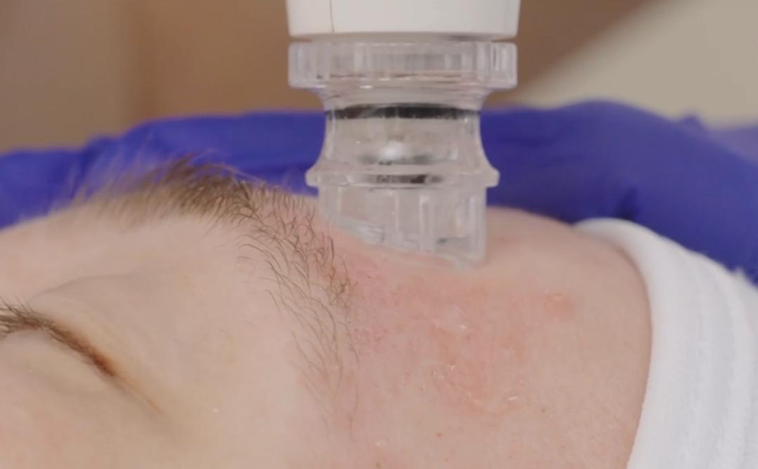 Hydrafacial tretman lica + vrata - Luxelumíe, Zagreb Tretman lica Lice Tretman lica, Zagreb, Maksimir